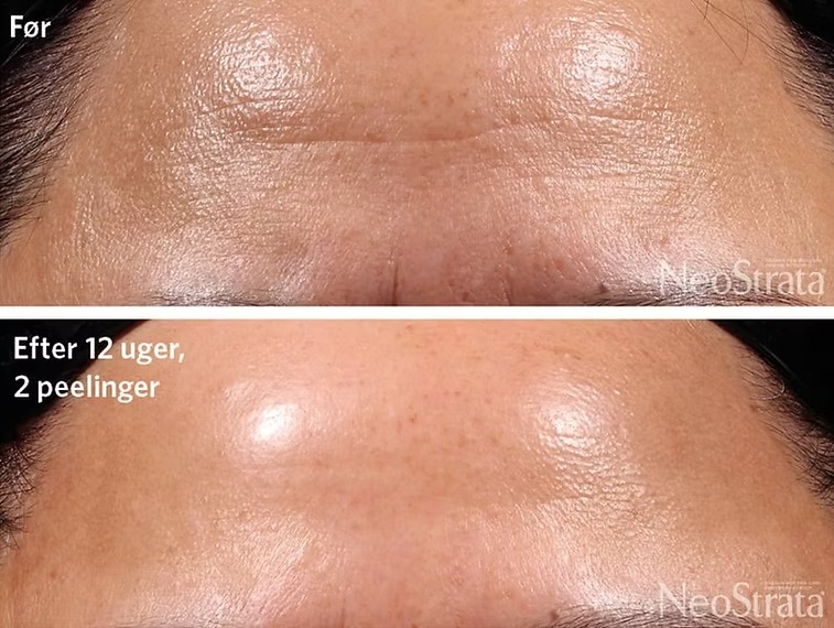 Kemisk peeling